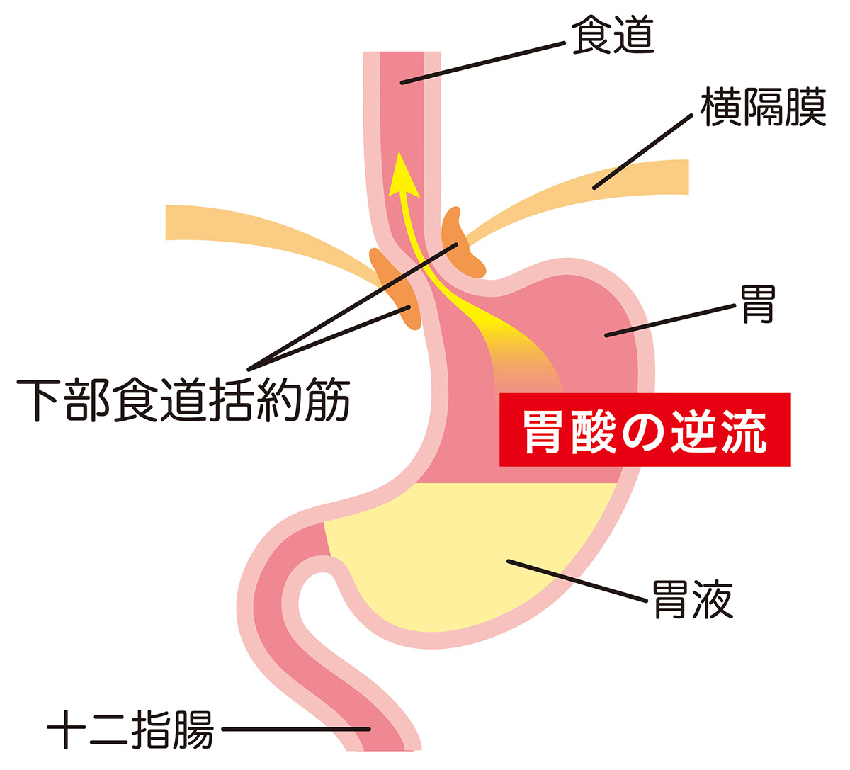 逆流性食道炎の原因