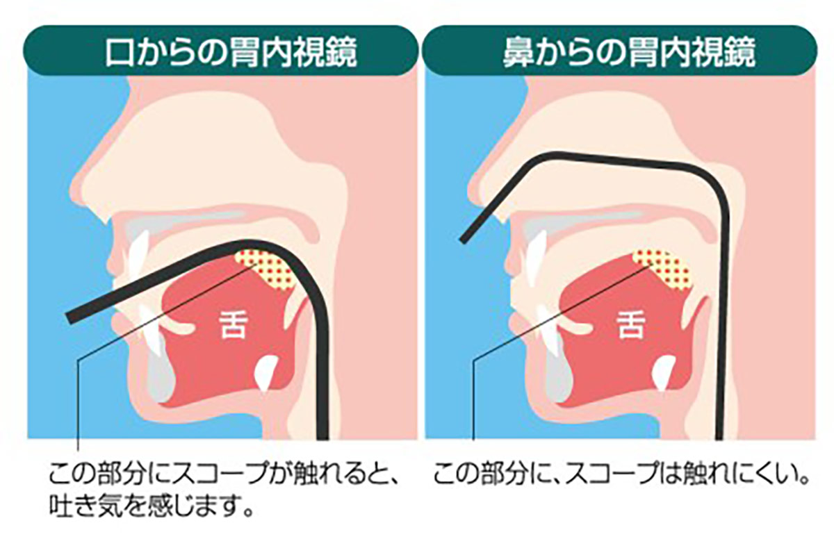 楽に受けられる経鼻内視鏡検査